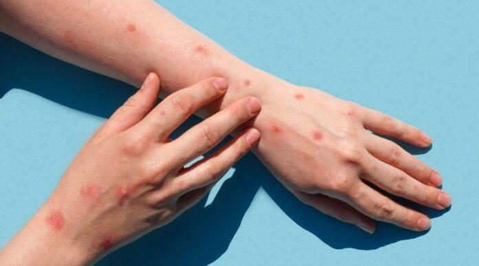 Is It Linked To Monkeypox Or Coronavirus? Here's What We Know