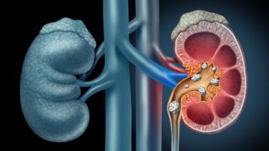 Can Kidney Stones Pass Without Surgery Experts Explain Remedies and Warning Signs