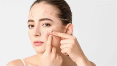 Persistent Face Pimples May Be Linked to Lifestyle and Hormonal Imbalance