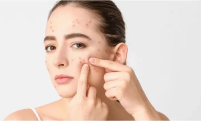 Persistent Face Pimples May Be Linked to Lifestyle and Hormonal Imbalance