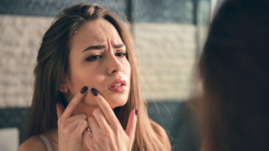 Struggling With Pimples Simple Daily Habits Can Bring Back Clear Skin