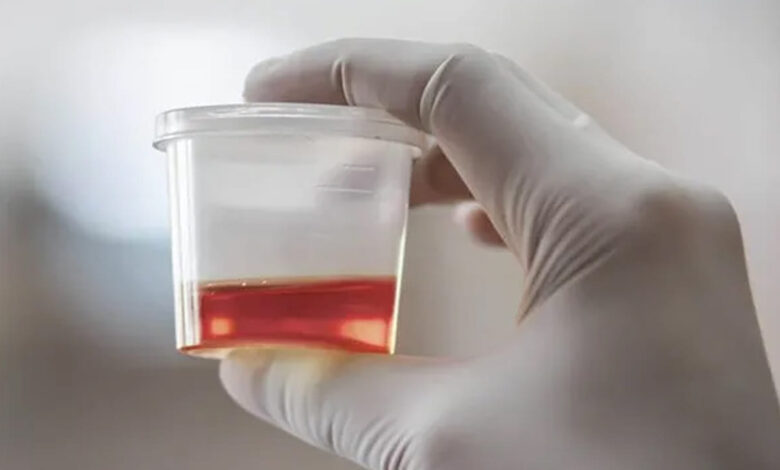 Blood In Urine A Warning Sign Of Kidney Cancer Or Something Else