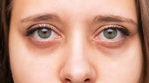 Dark Circles Under Eyes Rising Concern Among Youth and Working Professionals