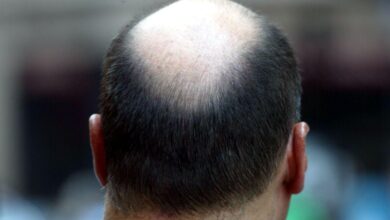 Hair Loss Linked to Gut Health Study Reveals Surprising Cause Behind Baldness in Men