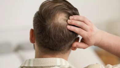 Rising Hair Loss in Young Adults Linked to Lifestyle and Health Factors
