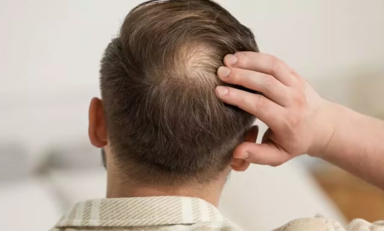 Rising Hair Loss in Young Adults Linked to Lifestyle and Health Factors