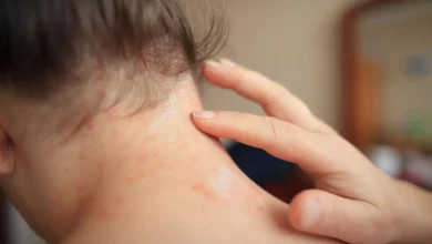 Summer Heat Rash in Children Causes Symptoms and Simple Ways to Protect Sensitive Skin
