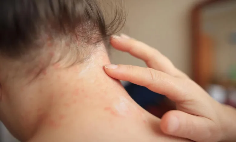 Summer Heat Rash in Children Causes Symptoms and Simple Ways to Protect Sensitive Skin
