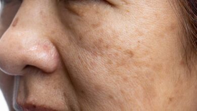 Why Dark Spots Appear on the Skin and Face as Experts Explain Causes and Simple Care Tips