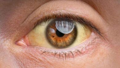 Yellowing Eyes May Signal Serious Liver Trouble Experts Urge Early Attention
