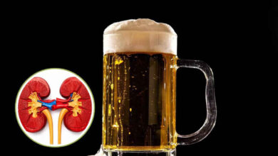 Debunking the Myth: Beer and Kidney Stones – What Doctors Really Say