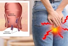 Foods That Can Make Piles and Constipation Worse
