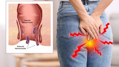 Foods That Can Make Piles and Constipation Worse