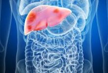 Parents Warned as Fatty Liver Cases Rise Among Children
